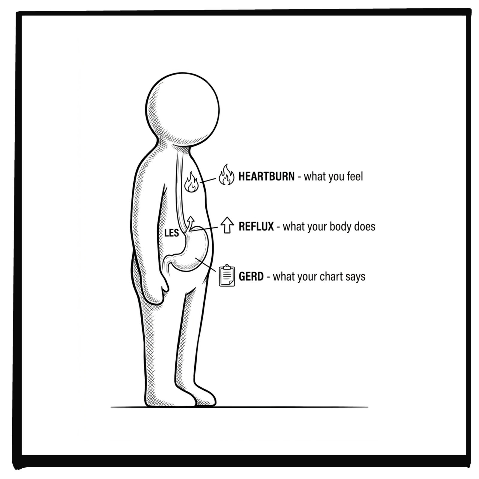 Acid Reflux vs. Heartburn vs. GERD: What's the Difference?