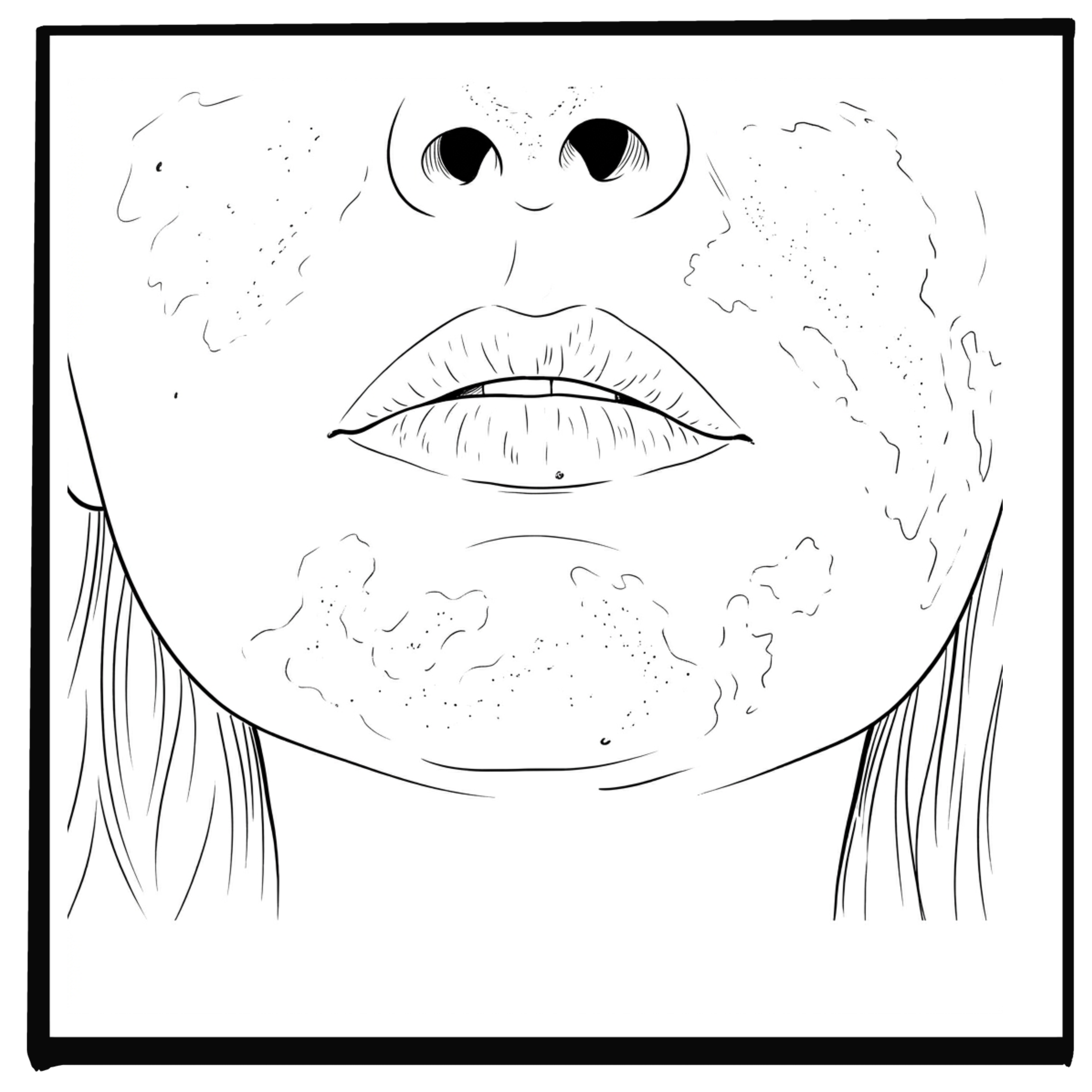 Is Your Rosacea Caused by SIBO?